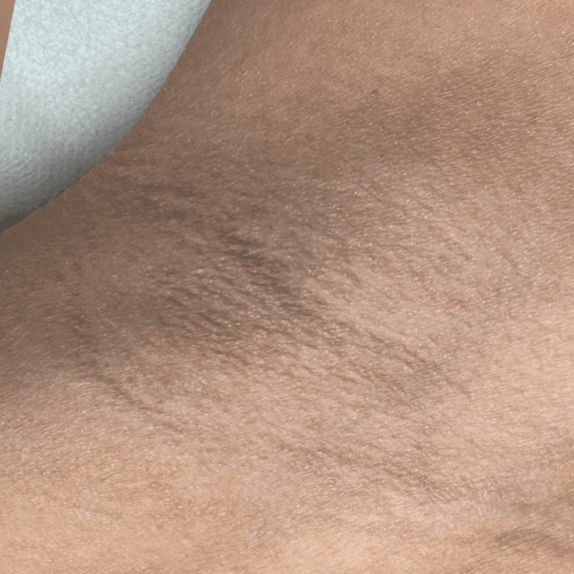 Underarms Unlimited – 1 Year at Electrolysis by Kate in Costa Mesa, CA