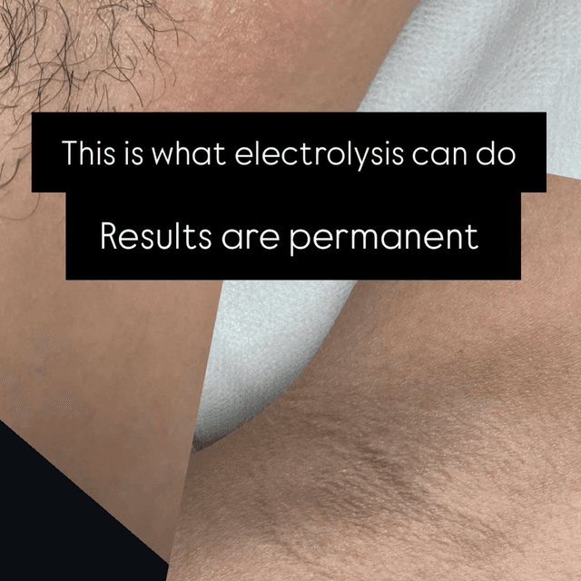 Underarms 6 treatments at Electrolysis by Kate in Costa Mesa, CA